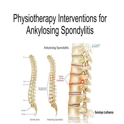 PT for Ankylosing Spondylitis