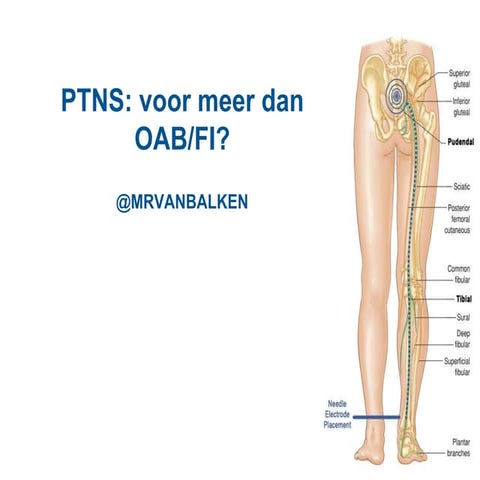PTNS: andere indicaties dan OAB en FI | PPTX