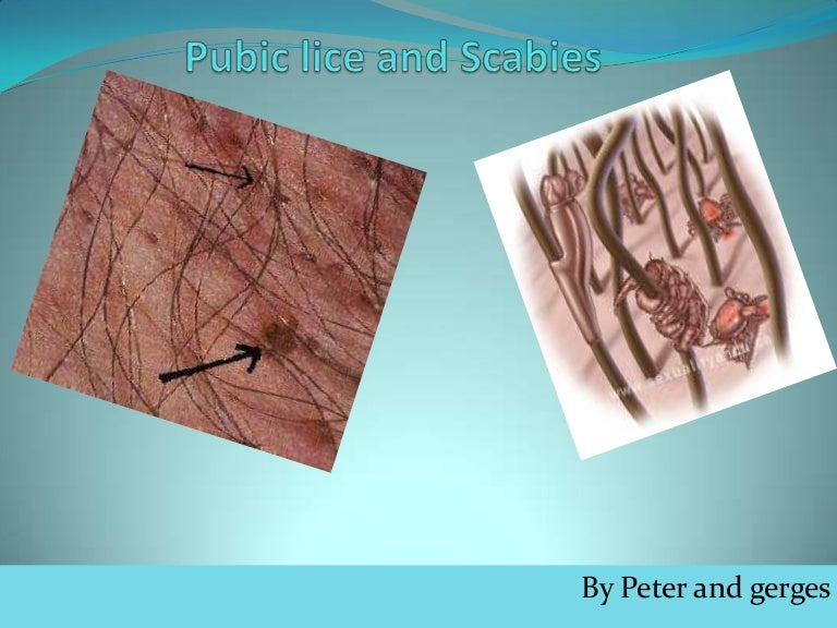 Pubic Lice And Scabies