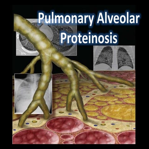 Pul.alv.proteinosis