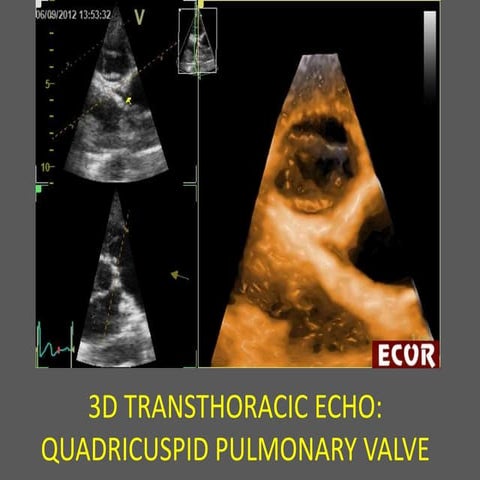Pulmonary quadricuspide