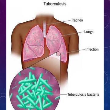 Tuberculosis.pptxniceeeeee veryy helpp ful good must | PPTX