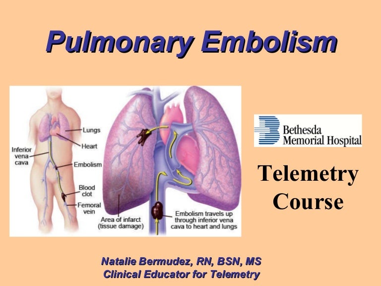 Pulmonary embolism