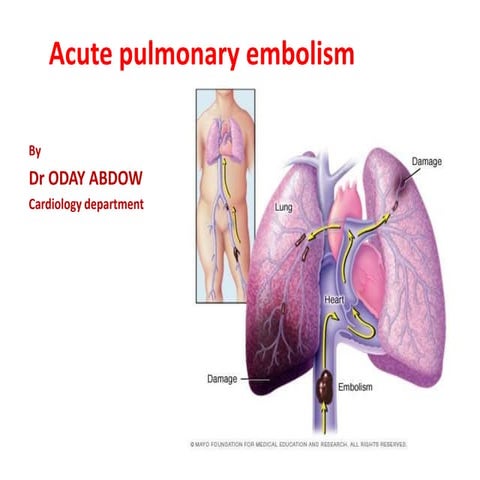 Pulmonary embolism