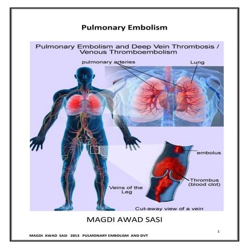 Pulmonary embolism | PPT