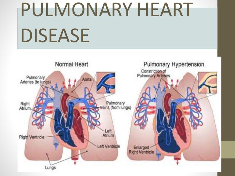 Pulmonary heart disease
