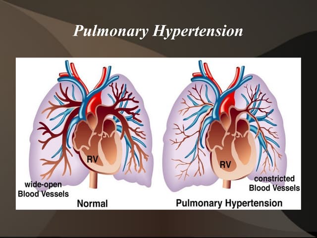 Pulmonary Arterial Hypertension (PAH) presentation | PPTX