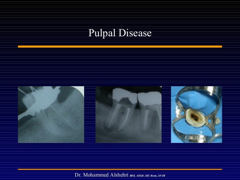Pulpal disease
