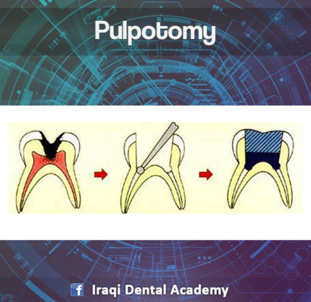 Pulpectomy Procedure Explained in brief