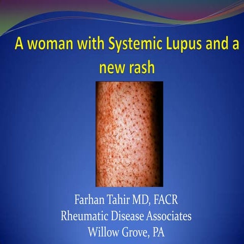 Pupura In A Patient With Lupus