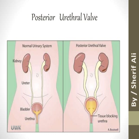Posterior Urethral Valves | PPTX