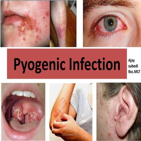 pyogenic infection.pptx
