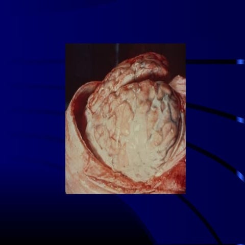 Pyogenic meningitis in child