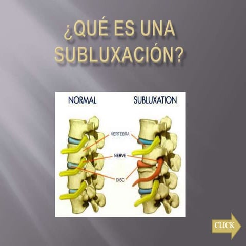 Síntomas De Subluxación _ Subluxación Causas Y Tratamiento – SEDQN