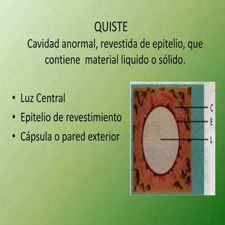 Quiste nasolabial y nasopalatino