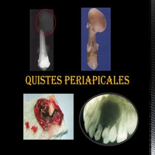 Quiste periapical 