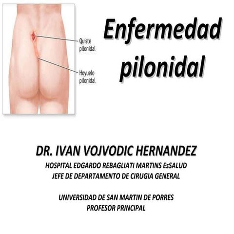 Enfermedad pilonidal | PPTX