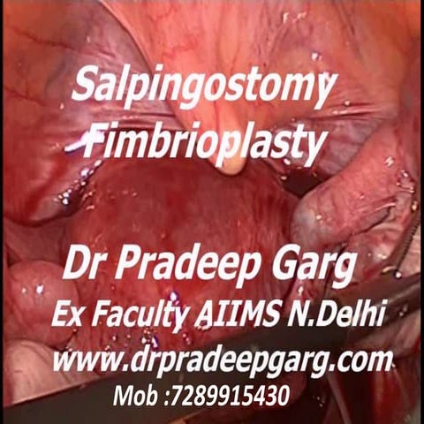 Salpingectomy : Fimbrioplasty ; Dr Pradeep Garg