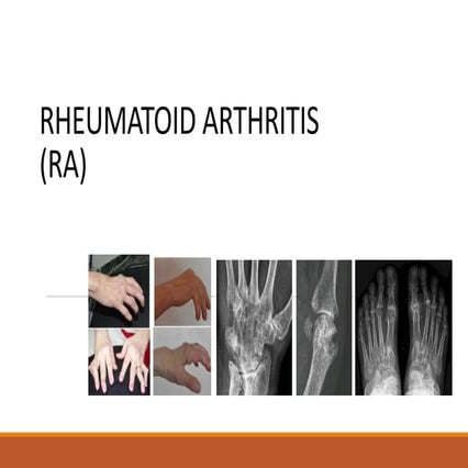 Rheumatoid arthritis | PPTX