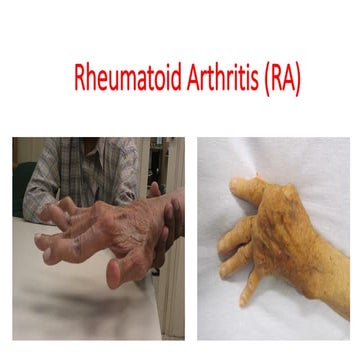 Comprehensive Overview of Rheumatoid Arthritis: Causes, Pathogenesis ...