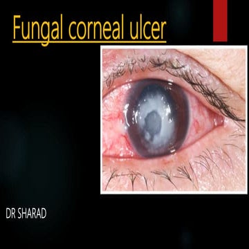 fungal / mycotic corneal ulcer power point presentation for O.A 2nd year stud...