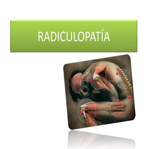 Radiculopatía | PPTX