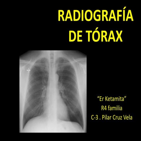 Interpretacion de radiografia PA de torax o tele de torax | PDF