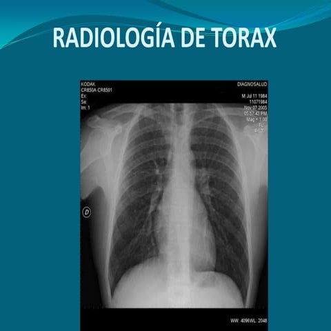 Interpretacion de radiografia PA de torax o tele de torax | PDF
