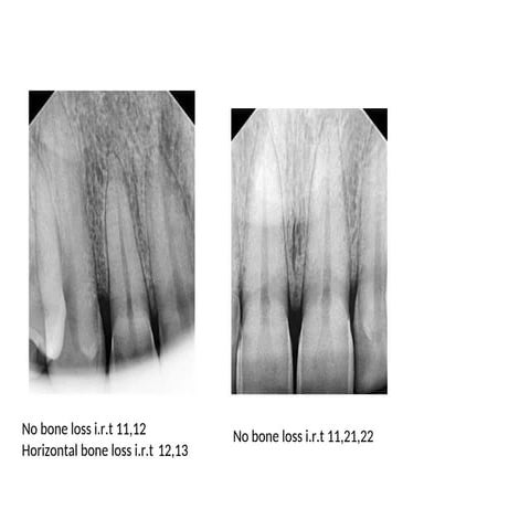 Radiograph of a patient having agressive Periodontitis | DOCX