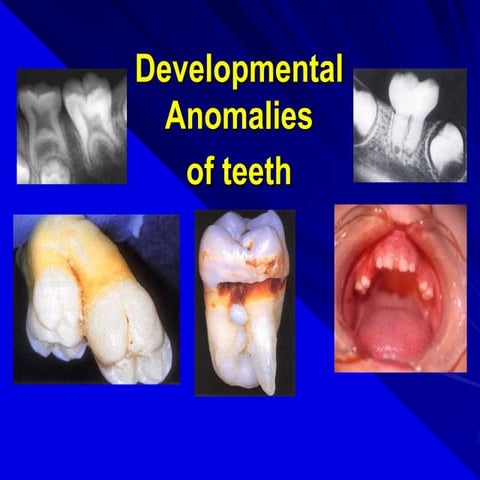 Developmental disturbances of teeth | PPTX