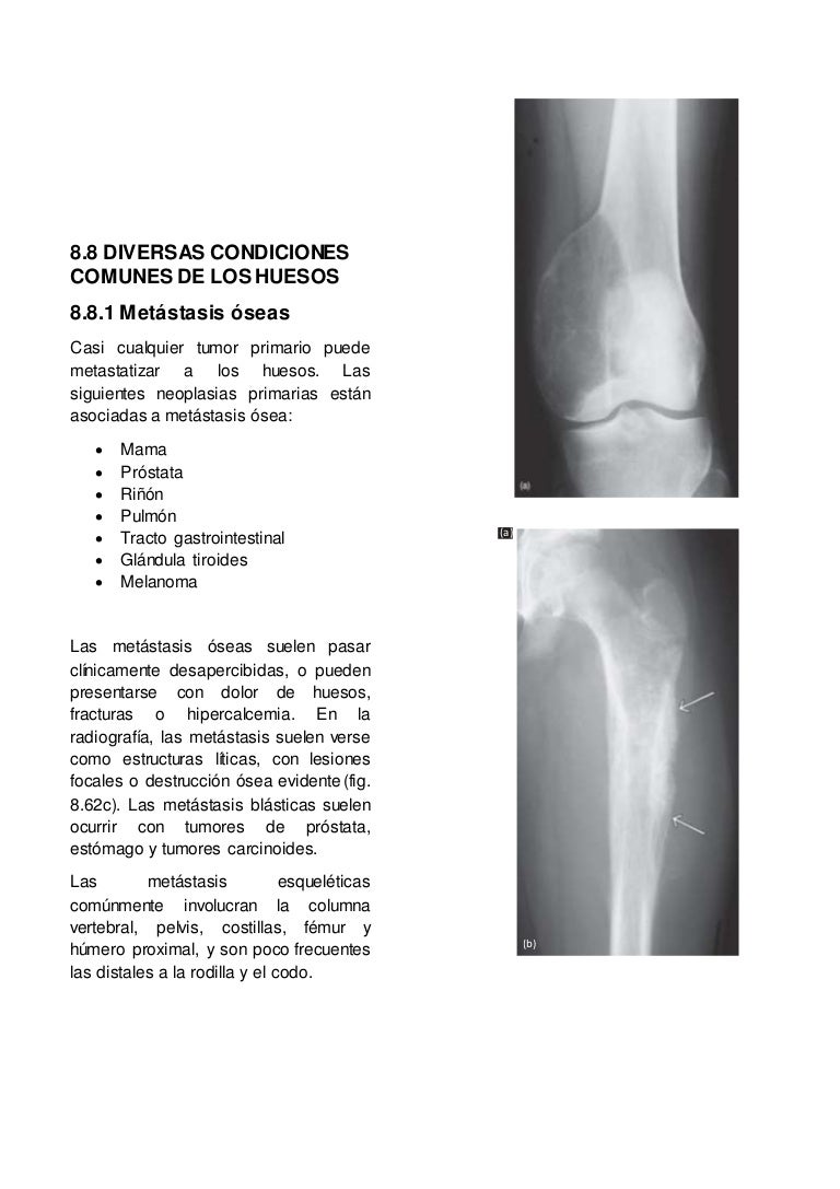 metastasis a columna por cancer de prostata