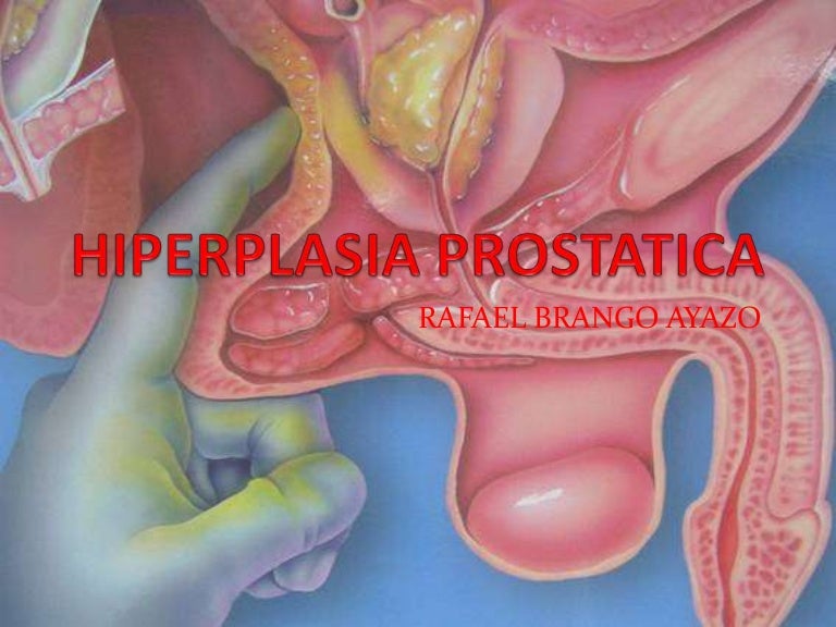 que es hipertrofia de prostata grado 4 que es hipertrofia de prostata grado 4