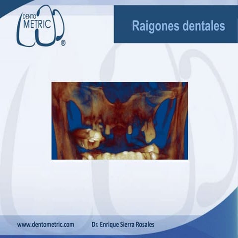 Raigones maxilar superior