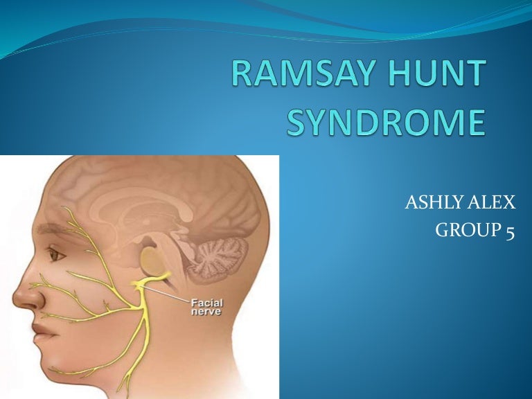 Ramsay Hunt Syndrome