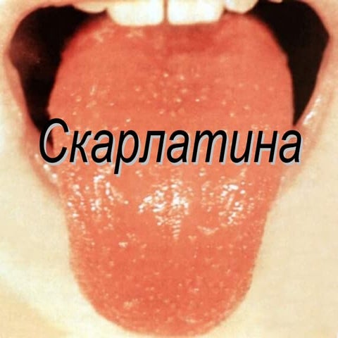 скарлатина презентация!!! | PPT