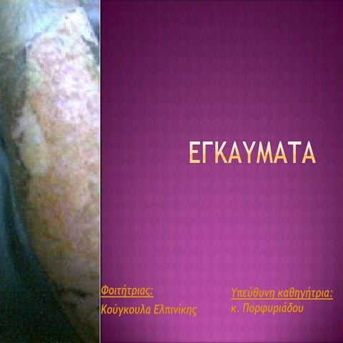 Εγκαυματα- Κούγκουλα Ελπινίκη