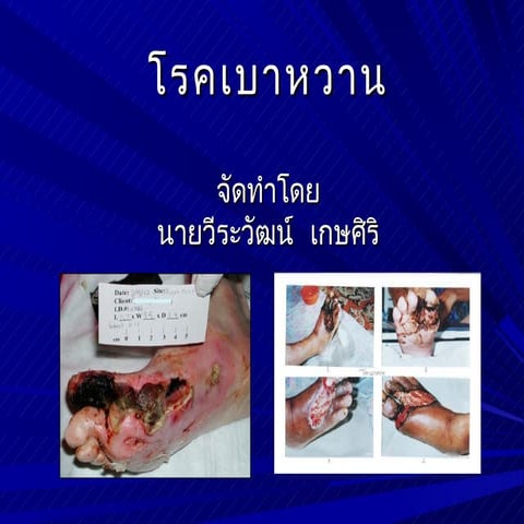 โรคเบาหวาน