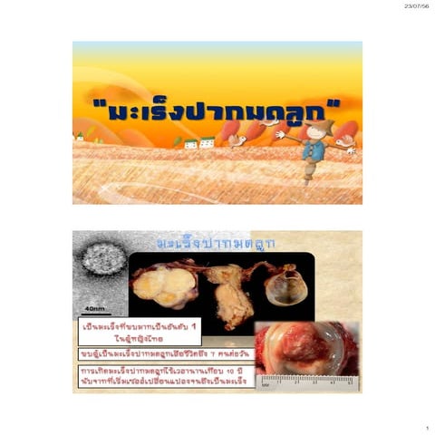 มะเร็งปากมดลูกและเต้านม