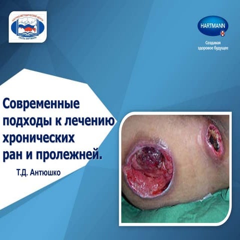 Современные Подходы К Лечению Хронических Ран И Пролежней | PPT
