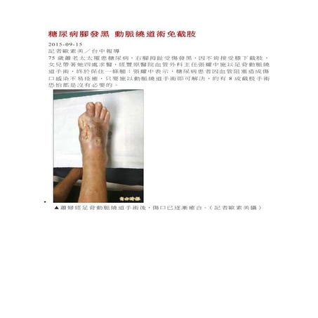 糖尿病腳發黑 動脈繞道術免截肢
