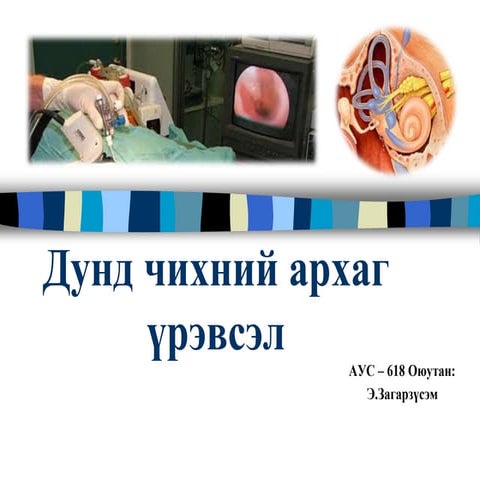 Дунд чихний архаг үрэвсэл | PPT