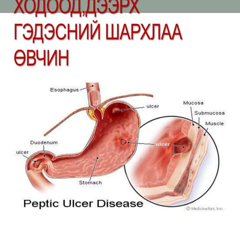 ходоод,дээрх гэдэсний шархлаа өвчин