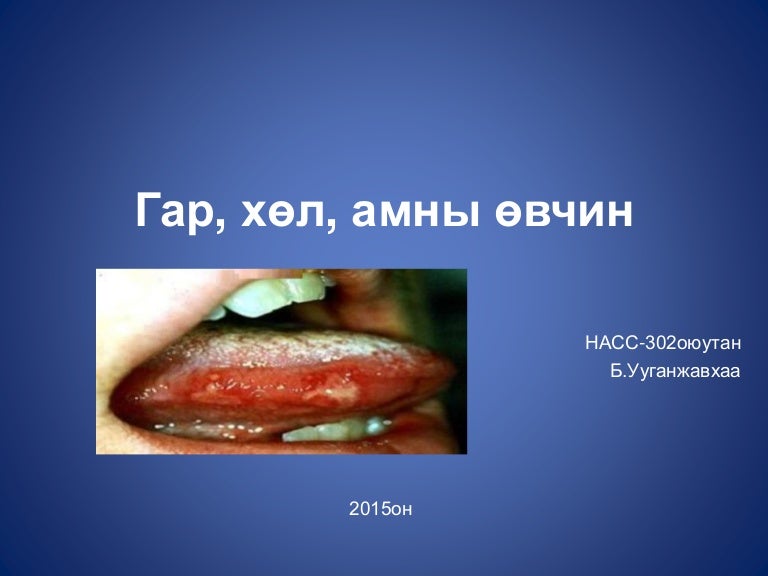 гар, хөл, амны өвчин