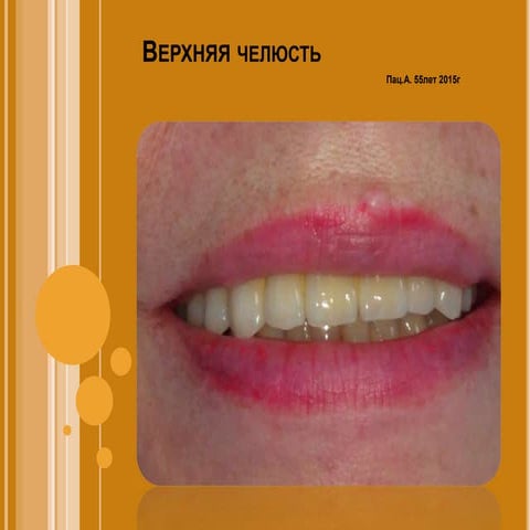 Протезирование верхней челюсти | PPT