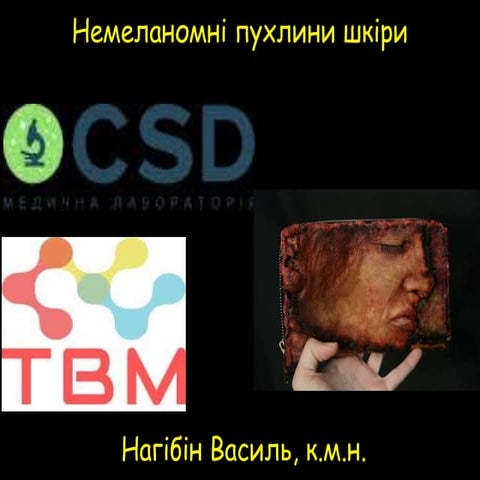 Нагібін В.С. - Немеланомні пухлини шкіри