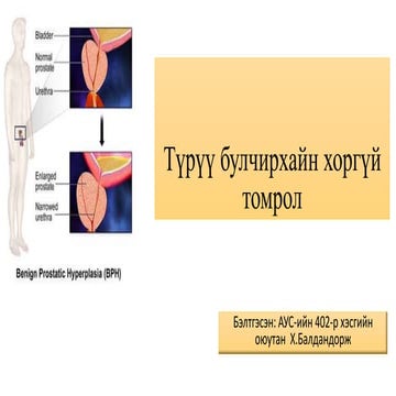 #Түрүү булчирхайн хоргүй-томрол.pptx