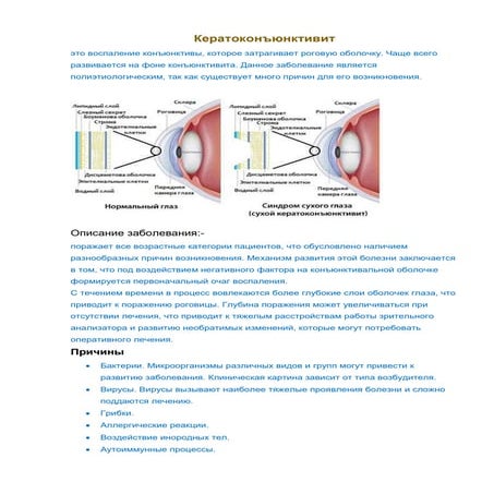 кератоконъюнктивит.doc