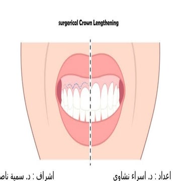 Esthetic crow lengthening surgery تطويل التيجان جراحيا.pptx