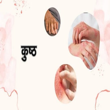 कुष्ठ.pptx this Kustha (Kushtha) –...... | PPTX