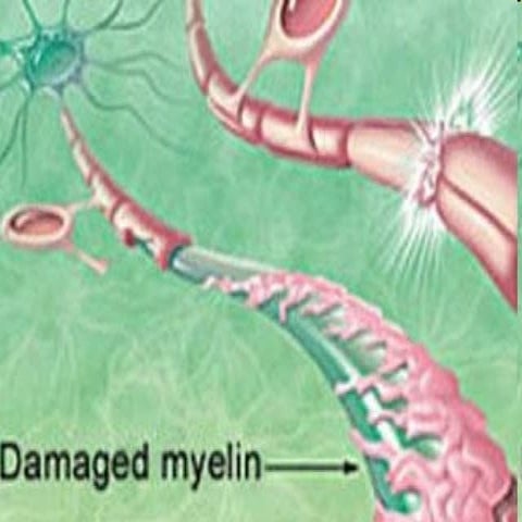 Multiple sclerosis | PPT